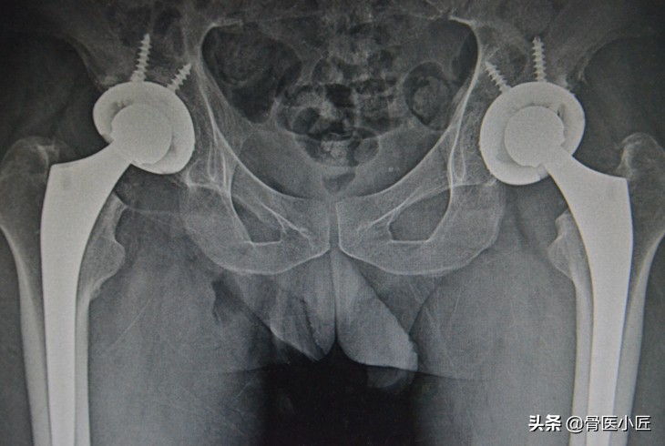 新冠肺炎医生用小剂量的激素,激素在新冠肺炎中的应用