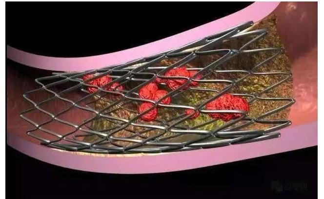 心脏支架后再狭窄怎么办,支架内再狭窄可以不管吗