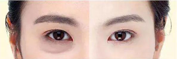 卧蚕和眼袋的区别,卧蚕与眼袋有什么区别