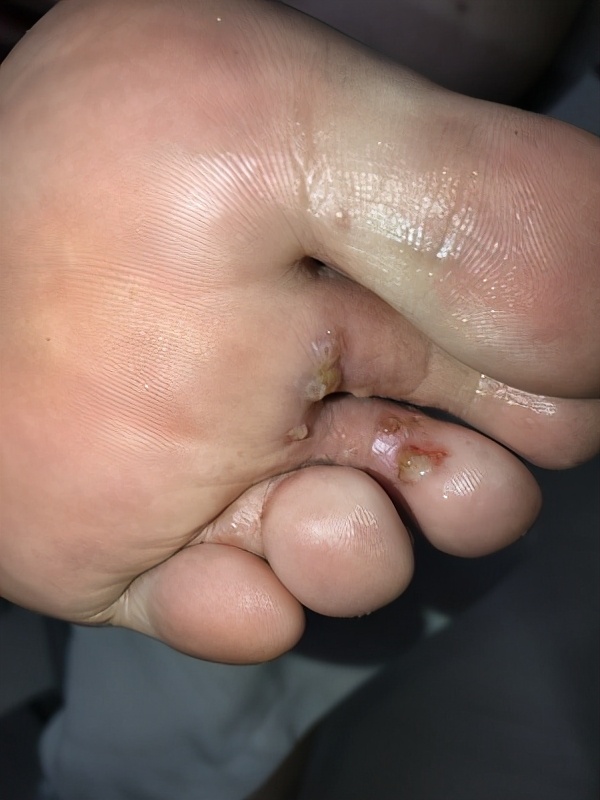 脚气反复奇痒无比,脚气引起全身痒怎么治