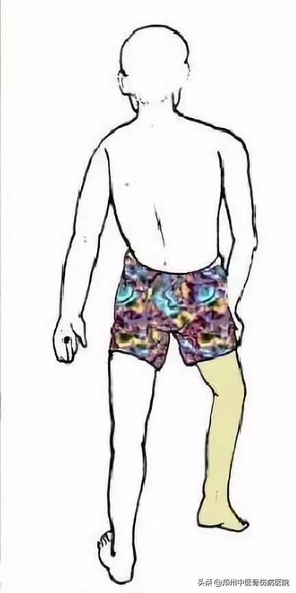 中医治疗股骨头坏死效果怎么样,中医是否可以治愈股骨头坏死