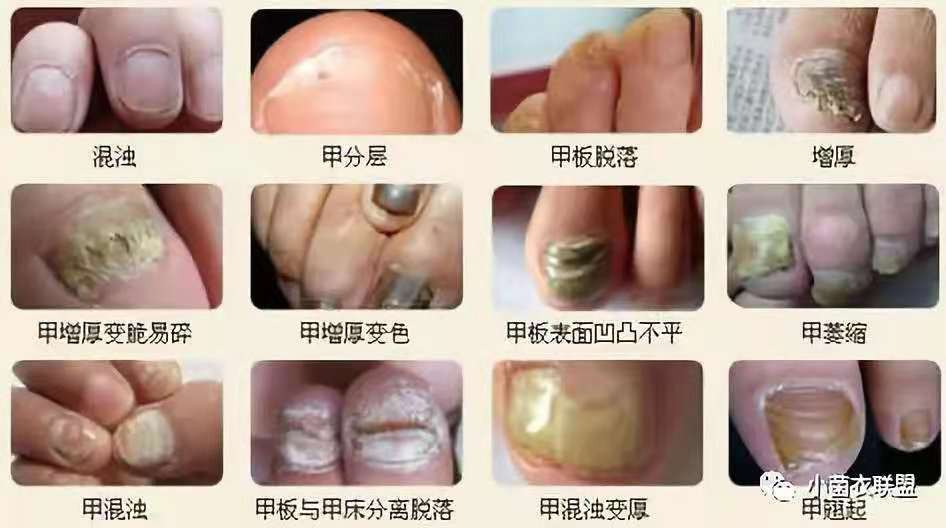 远离真菌感染,真菌性皮肤病的克星