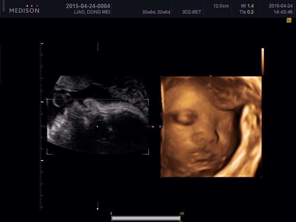 四维图片看着胎儿鼻子大怎么回事,胎儿四维彩超显示脑门大