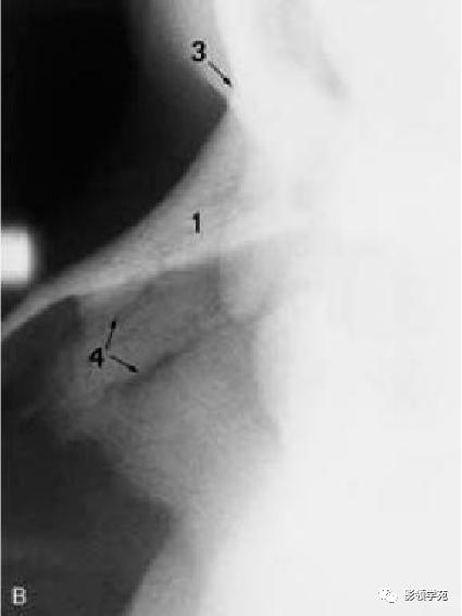 鼻骨影像学解剖,鼻骨解剖及骨折影像学诊断