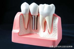 大牙没了怎么办,大牙没了用什么方法弥补