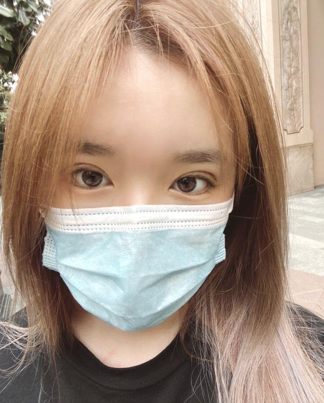 全切提肌案例,姐妹们做全切双眼皮都多少钱