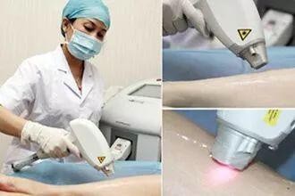 哪种毛适合激光脱毛,最近的激光脱毛