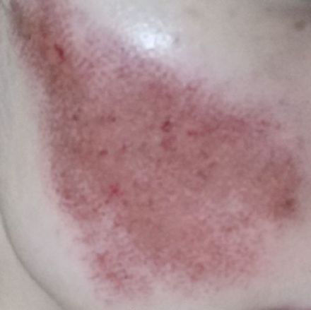 点阵激光能把伤疤完全修复吗,激光点阵可以修复到多少程度