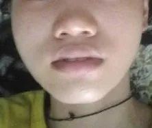 鼻翼缩小和鼻头缩小需要全麻吗,鼻头缩小和鼻翼缩小有什么区别