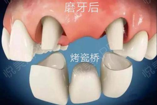 明星做烤瓷牙会做根管治疗吗,烤瓷牙的明星