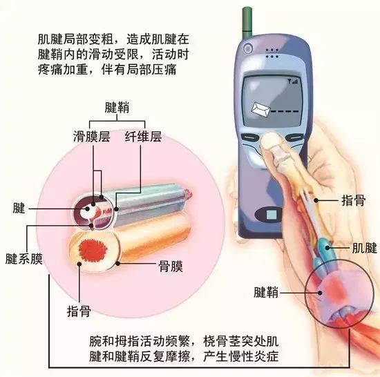 玩手机拇指腱鞘炎能好吗,玩手机腱鞘炎中指