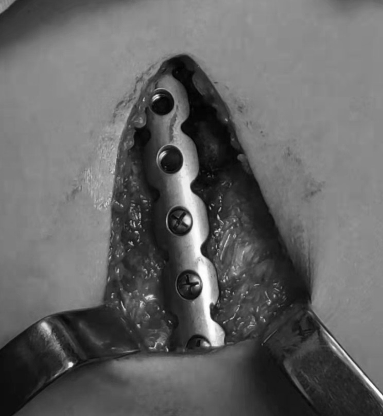 多发性肋骨骨折引发胸廓畸形矫正,股骨下端粉碎性骨折三维重建