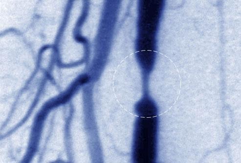 涨姿势！男性勃起障碍很可怕？听过用松紧带和真空泵