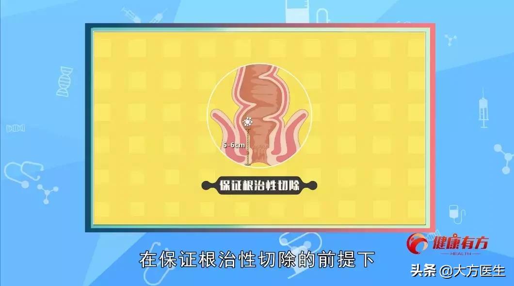 直肠癌保肛术手术方法,直肠癌想保肛可以不用手术治疗吗