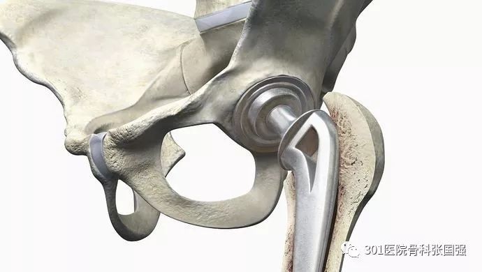 先天性髋关节脱位可以顺产吗,先天性髋关节脱位手术费多少