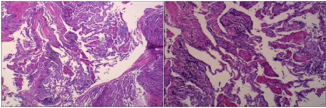 抗感染治疗后效果欠佳，感染非感染？TBLB和肺穿刺病理有哪些提示