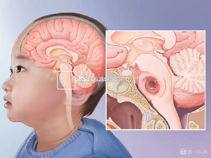 小孩脑干肿瘤保险赔吗,脑干出血哪些保险赔