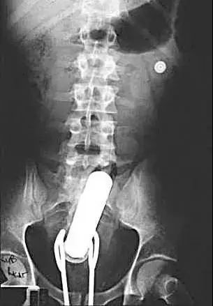 进去容易出来难：直肠异物，问题比“丢人”严重得多