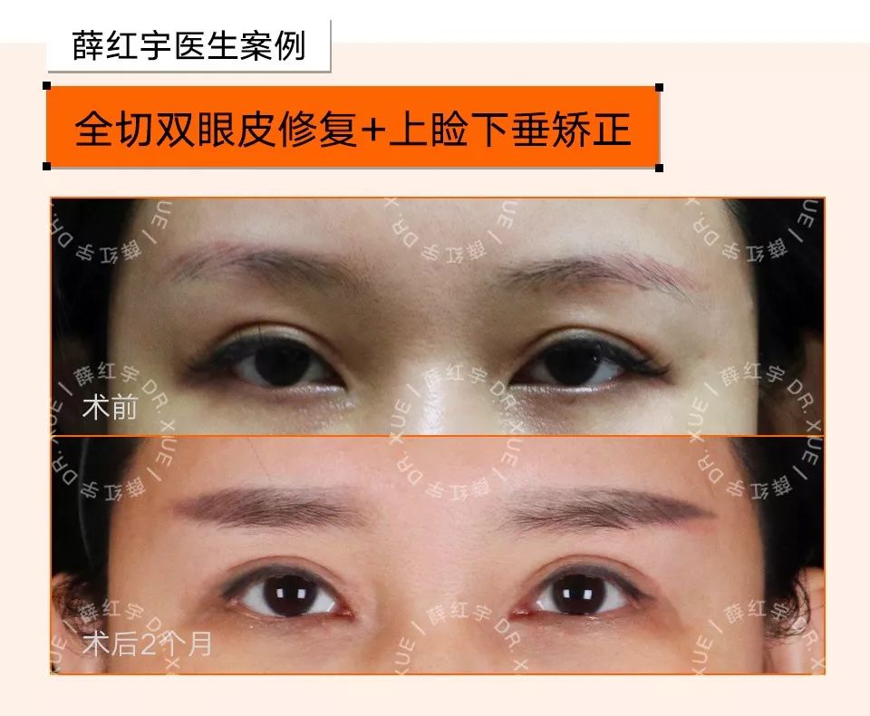 双眼皮整形修复,潘贰双眼皮修复