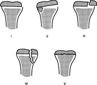 几种严重骨折医学名称,常见的骨折有哪些名称