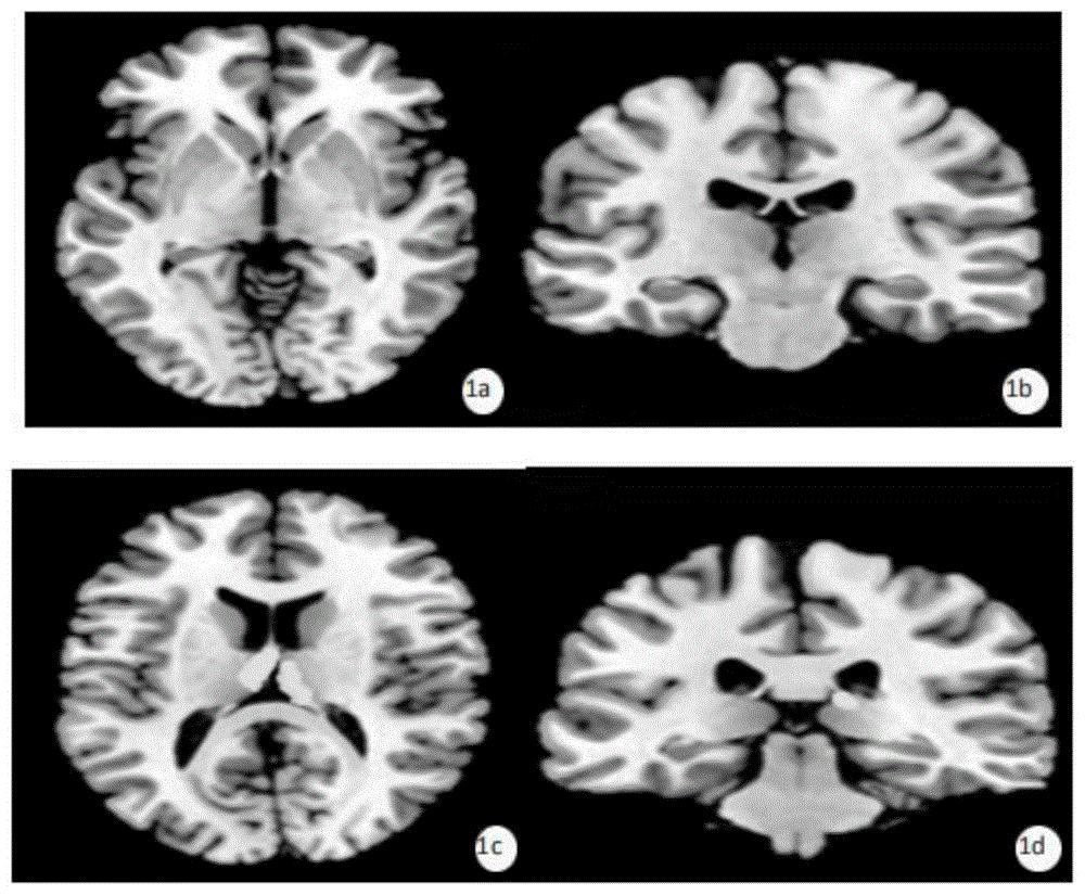 儿童脑白质病变是怎么回事,小脑脑白质海绵状变性综合征