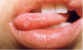 口腔溃疡就一定是“上火”吗?得了口腔溃疡怎么办?