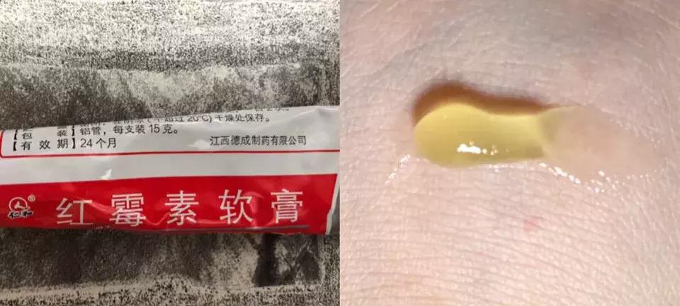 祛痘去黑头五次多少钱,祛痘100块钱