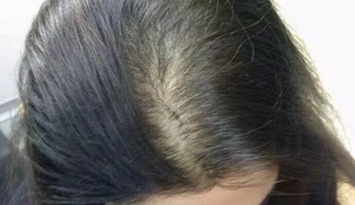 头顶脱发是肾精亏虚吗,头顶脱发是血虚