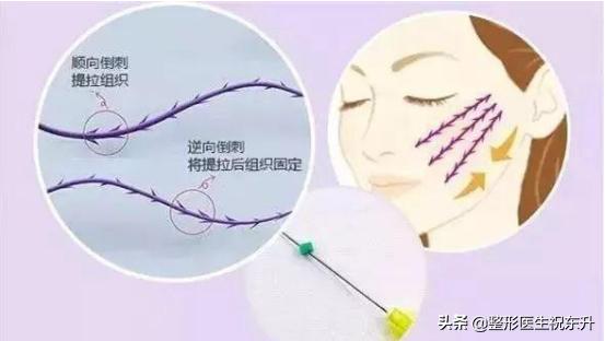 30岁做线雕提升还是筋膜悬吊,最新抗衰线雕