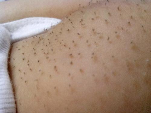 40天宝宝出现“猪毛风”，细心宝妈拔掉黑刺，反被医生怒斥太无知