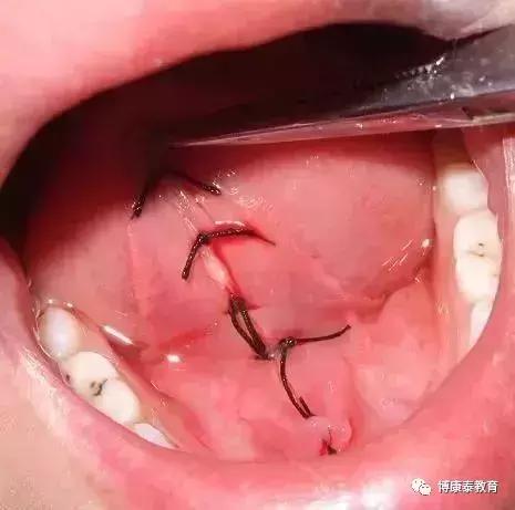 博康泰丨剪舌筋：该不该让孩子挨这一刀？