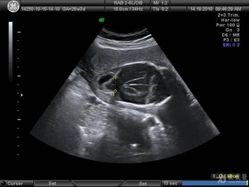 胎儿38周检查多囊肾但是羊水不少,怀孕21周羊水太少引产