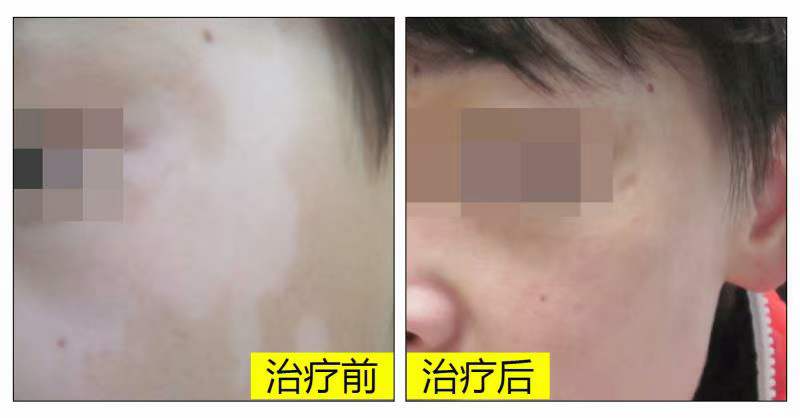 白癜风prp疗法多长时间一个疗程,白癜风光疗一个疗程需要做多少次