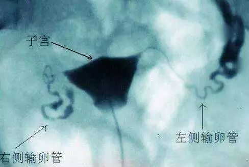 如果输卵管堵塞可以促排吗,输卵管不通畅可以促排吗