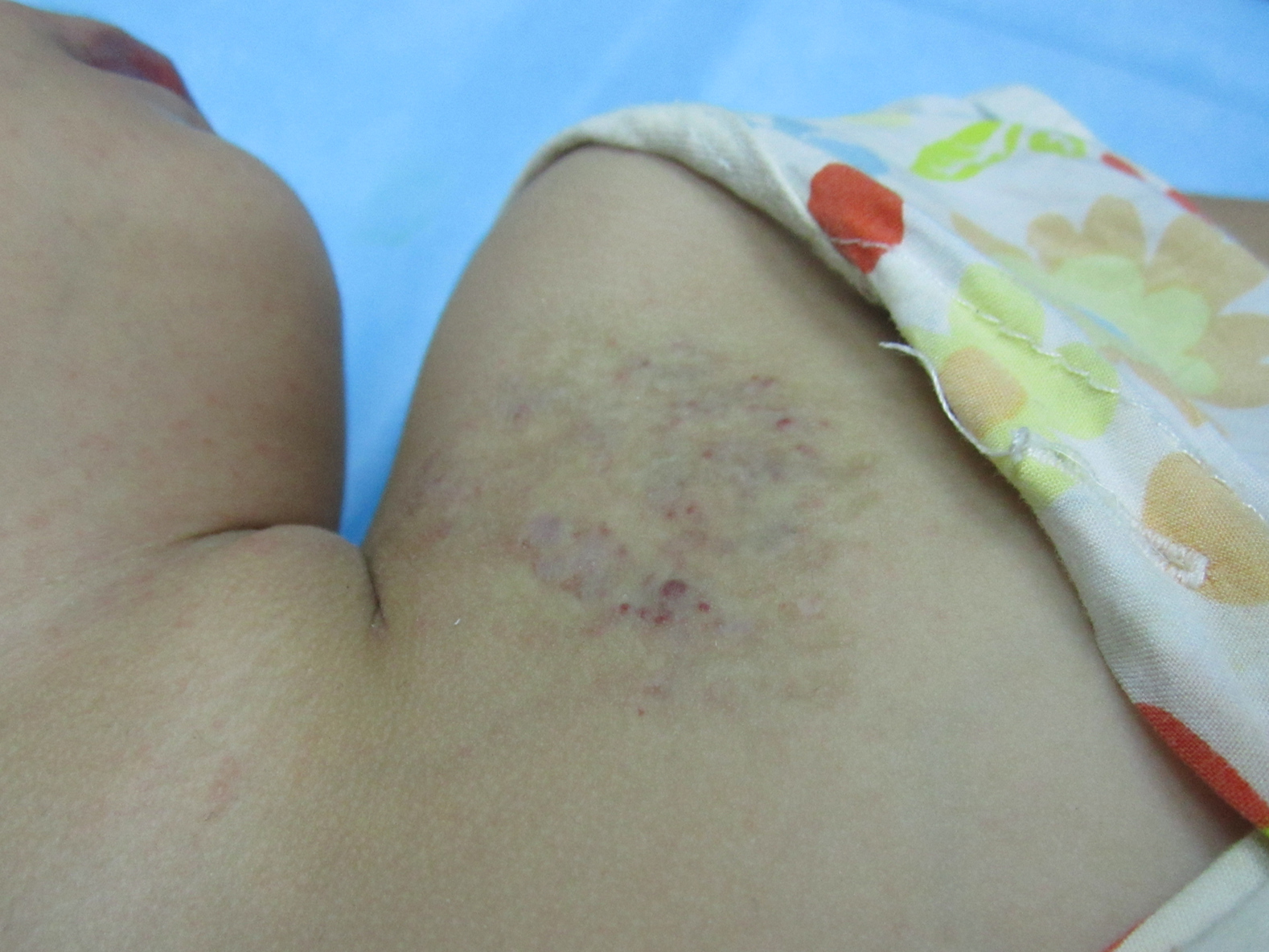 2岁女儿血管瘤,2岁小女孩肝血管瘤