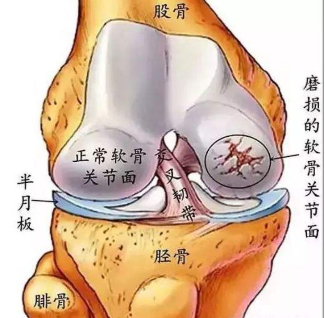 关节退变走路疼怎么治疗,关节退变一个疗程打几针