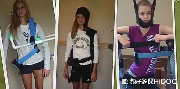 儿童颈椎侧弯会有什么后果,13岁孩子颈椎侧弯矫正睡姿图片