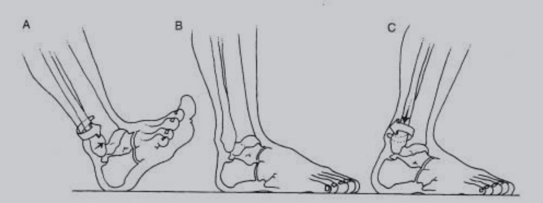 踝关节扭伤两个多月走路还跛脚,踝关节扭伤五个月了走路很痛还肿