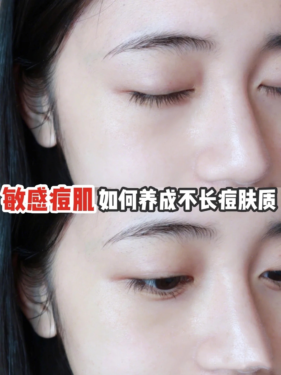 如何远离痘痘肌,远离痘痘的方法