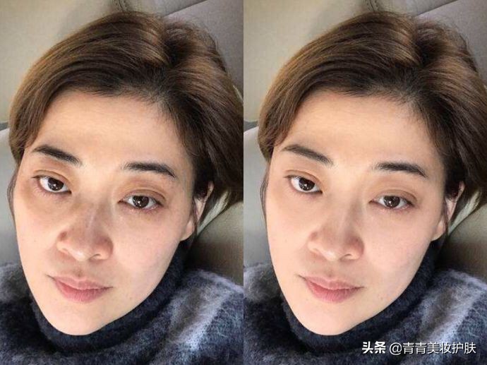 黑眼圈的类型及医美治疗方法,黑眼圈用什么方法拯救才好