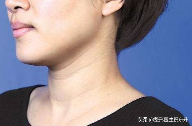 小女孩颈纹是怎么形成的,脖子上的颈纹是怎么形成的