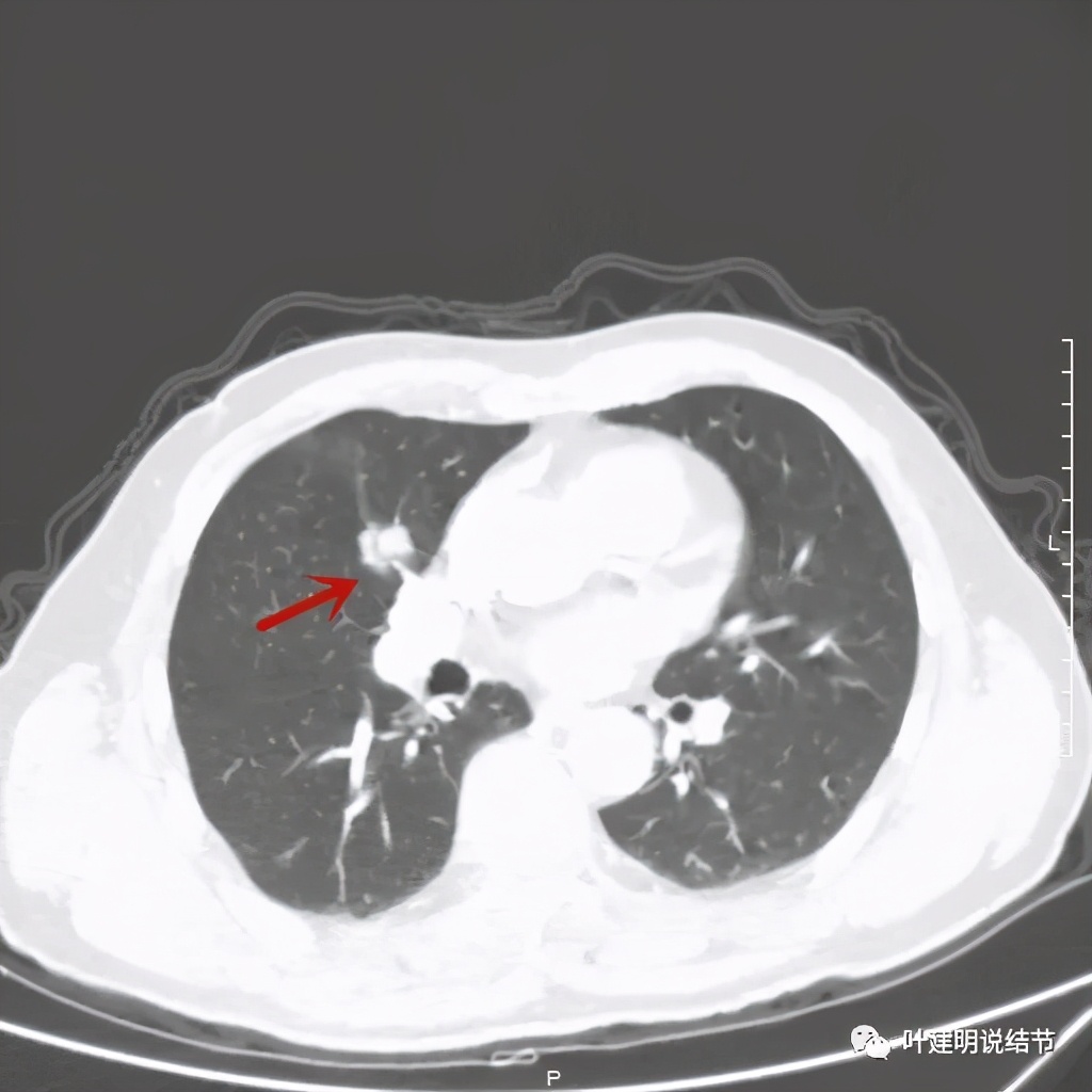 实性结节影要不要紧,实性结节穿刺活检为良性