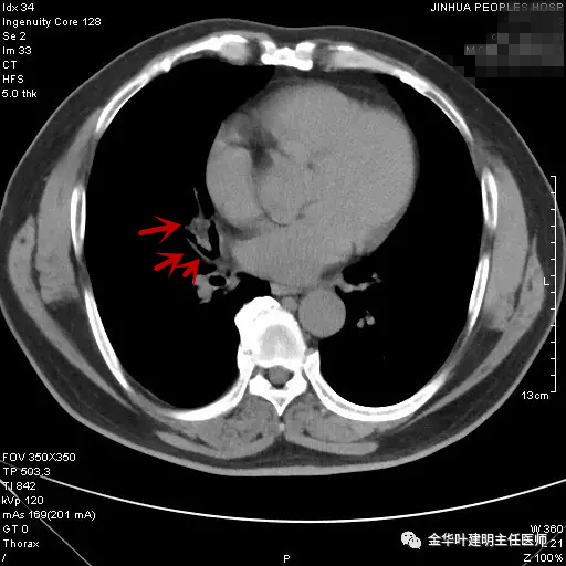 警惕反复发烧,警惕反复感染