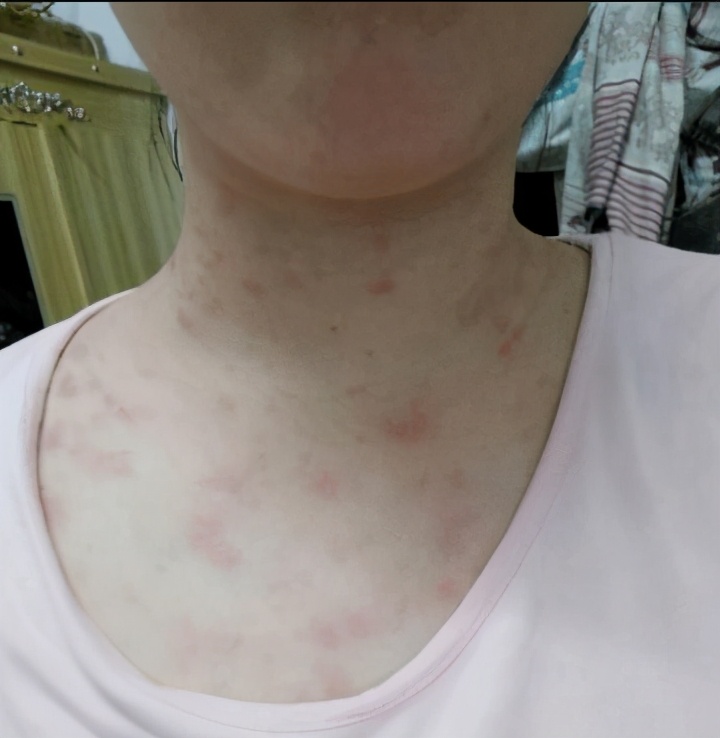 皮肤病玫瑰糠疹,玫瑰糠疹皮肤病