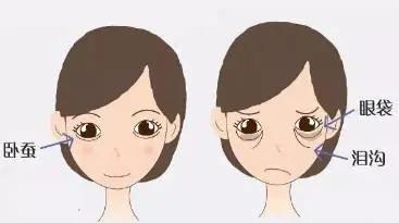 眼袋怎么变卧蚕整形图片,外切眼袋保留卧蚕怎么没有卧蚕呢