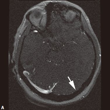 颅内血管周围间隙的影像鉴别,颅脑血管源性疾病影像诊断