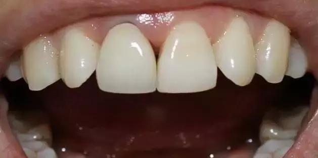 牙缝里黑黑的东西图片,牙缝里黑黑的是什么原因