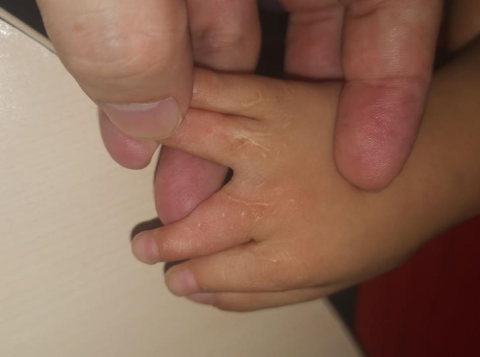 并指畸形免植皮案例,并指畸形