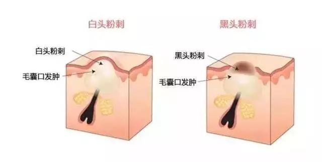 粉刺痘印脓包怎么区分好坏,维a胶囊治疗痘痘有作用吗