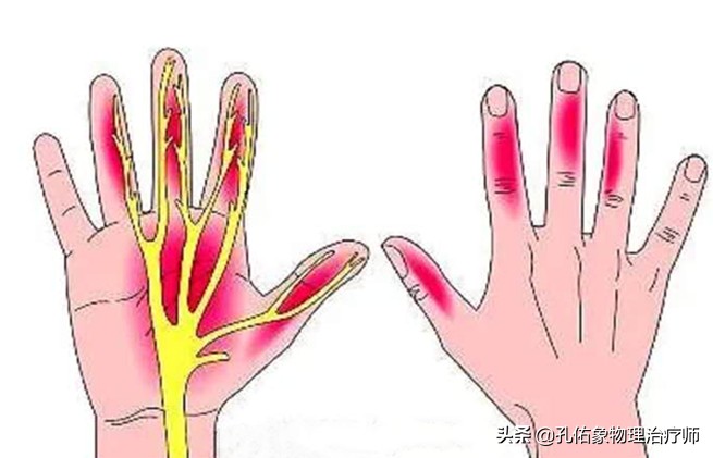 手指麻木是三大疾病前兆,手指麻木疼痛怎么治疗最好